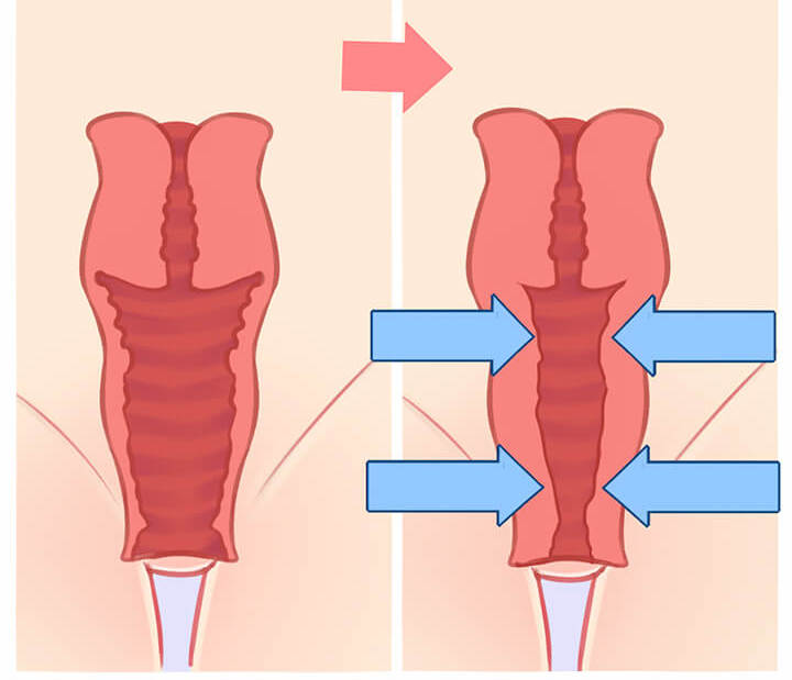 Vaginal tightening results after treatment - restored tightness and enhanced sensation Henderson NV